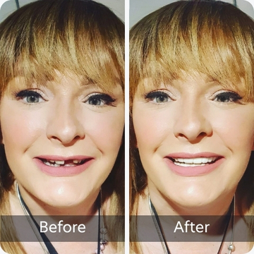 Missing Teeth teeth