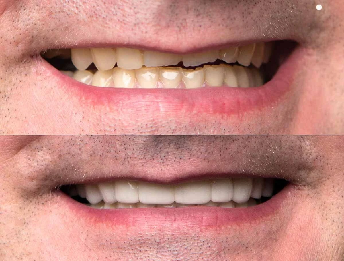 3D CAD design of persons top teeth with chip on front tooth