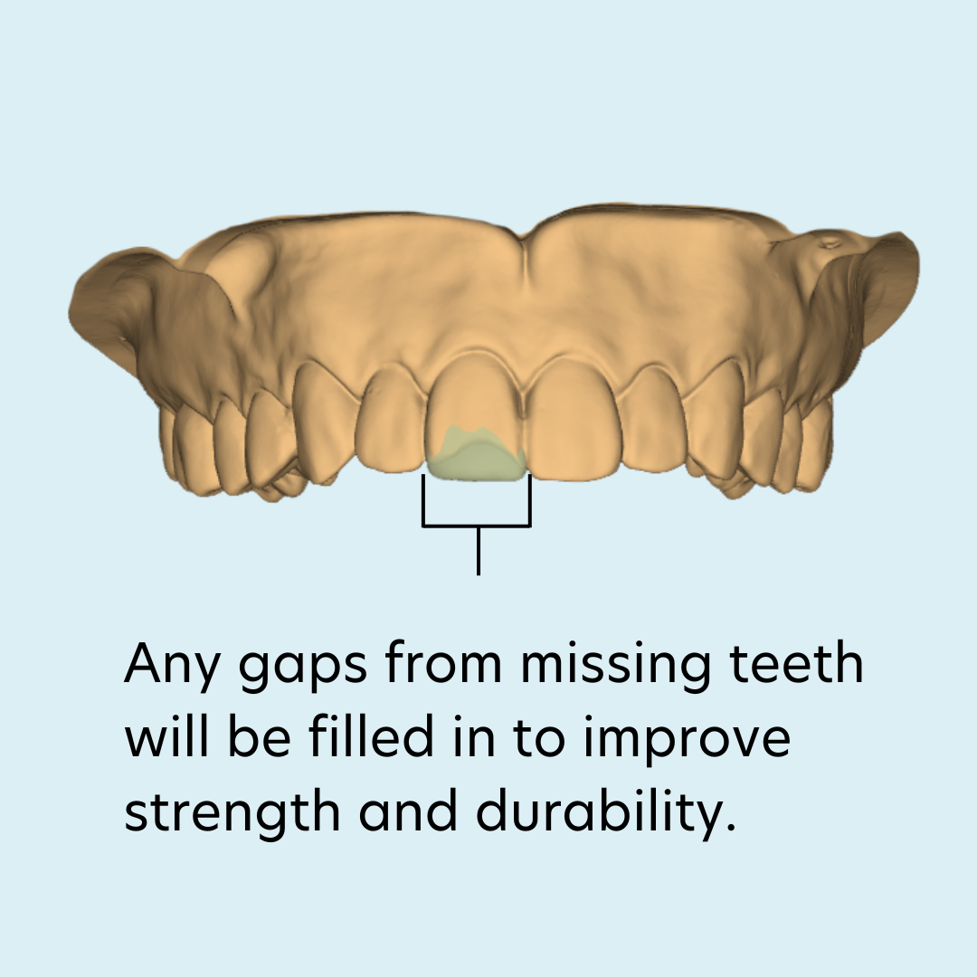 Covering chipped section of tooth example