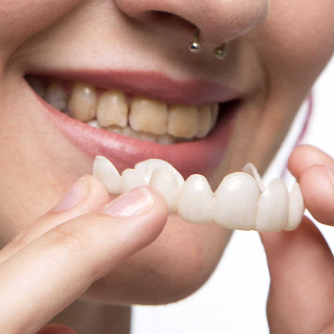 Example of a person putting the veener