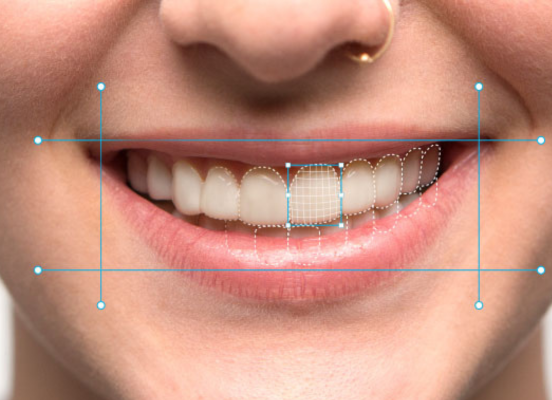 Woman playing Instasmile veneers on her upper teeth