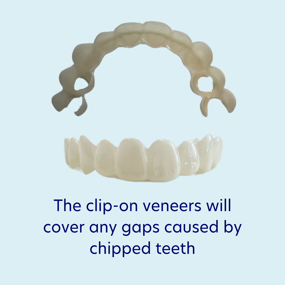 Result example for chipped teeth