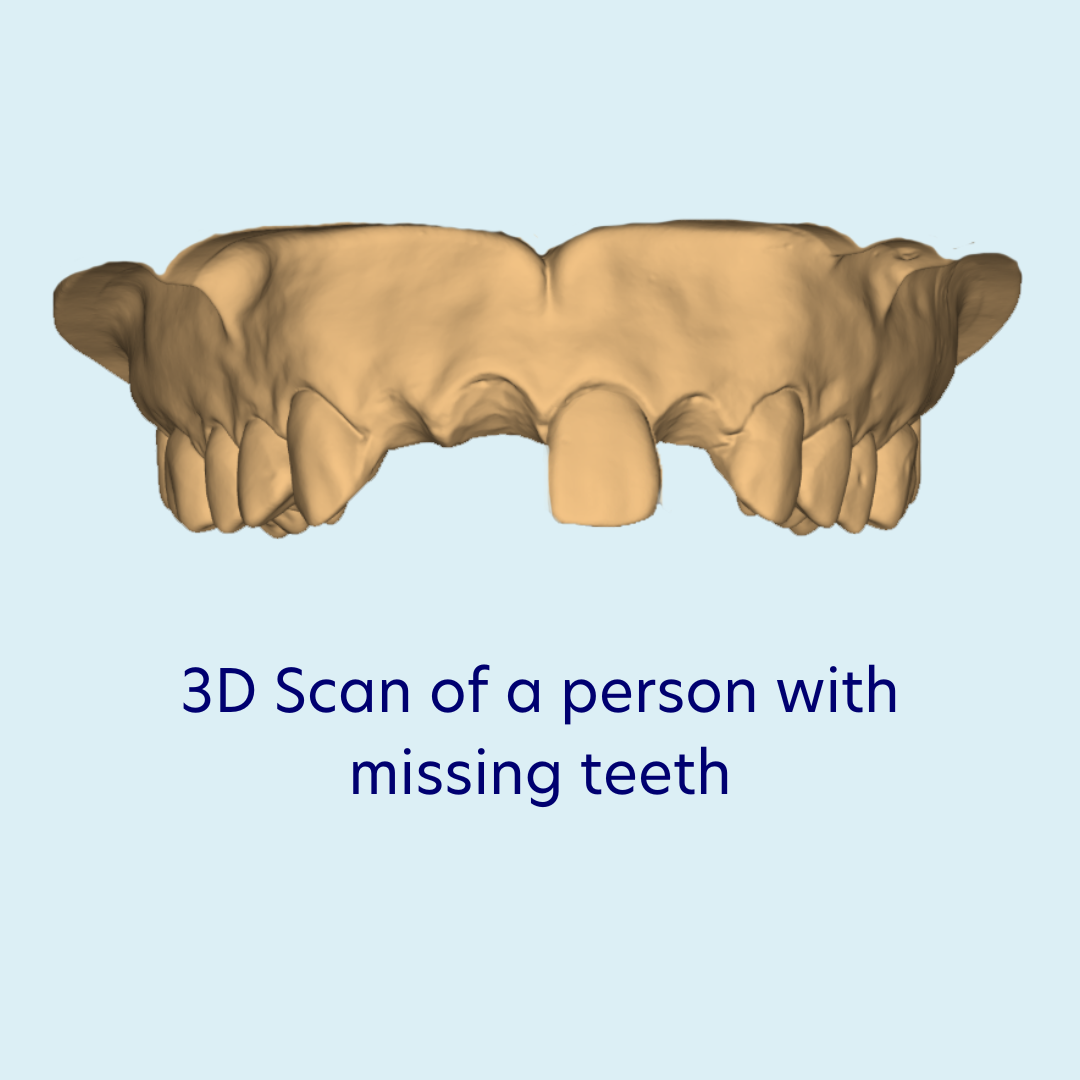 3D Scan of a person with missing teeth