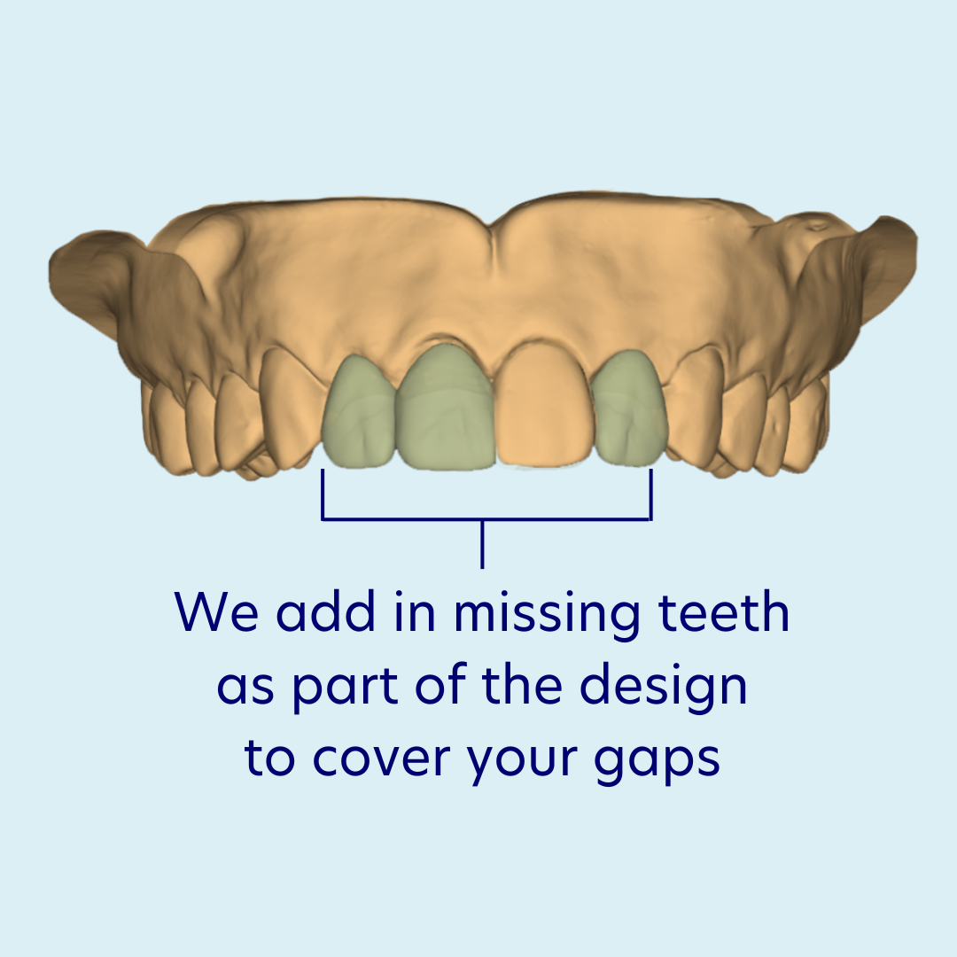 Adding missing teeth example