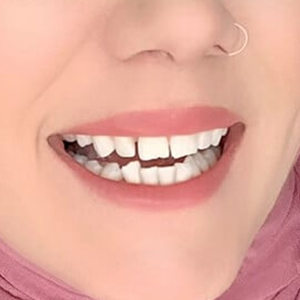 Design No Missing Teeth
