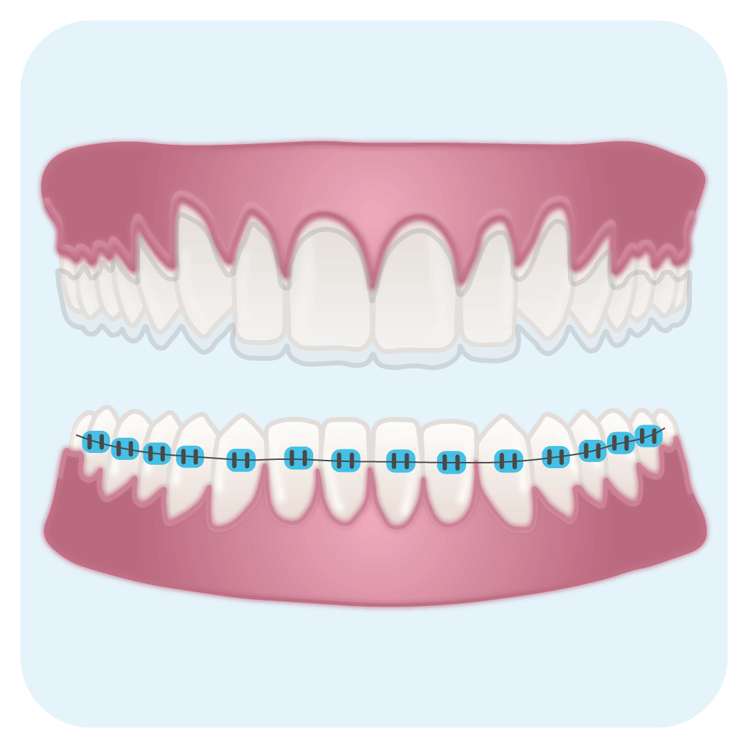 instasmile is an alternative to braces or aligners