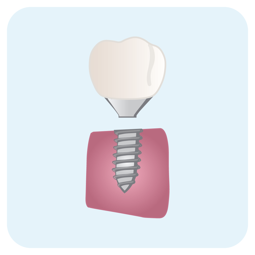 instasmile is an alternative to dental implants