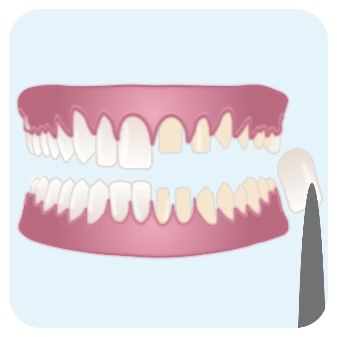 instasmile is an alternative to porcelain veneers