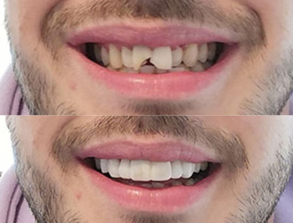 3D CAD design of persons top teeth with chip on front tooth