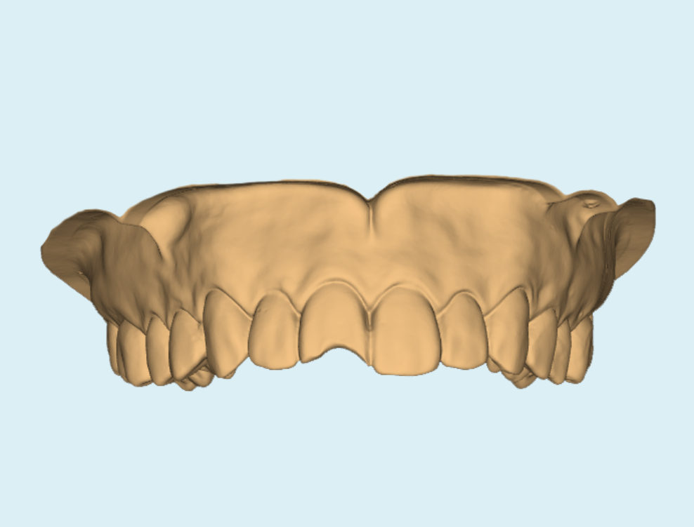 3D CAD design of persons top teeth with chip on front tooth