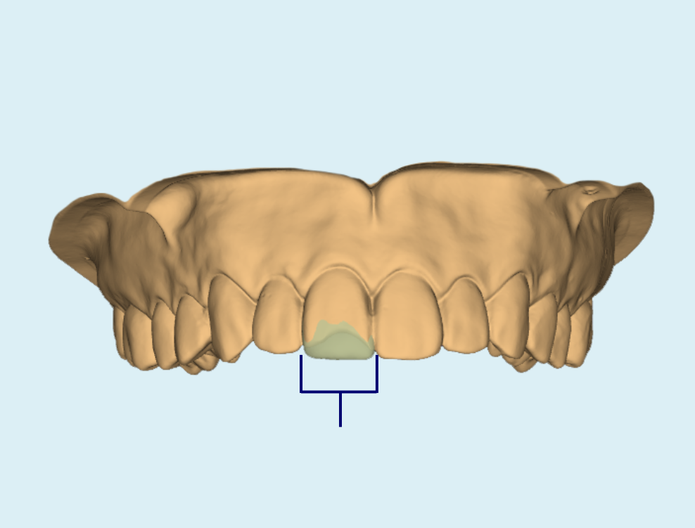 3D CAD design of persons top teeth with chip on front tooth