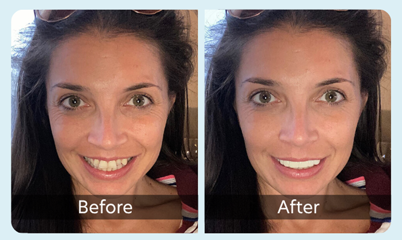 teeth with chip on front tooth