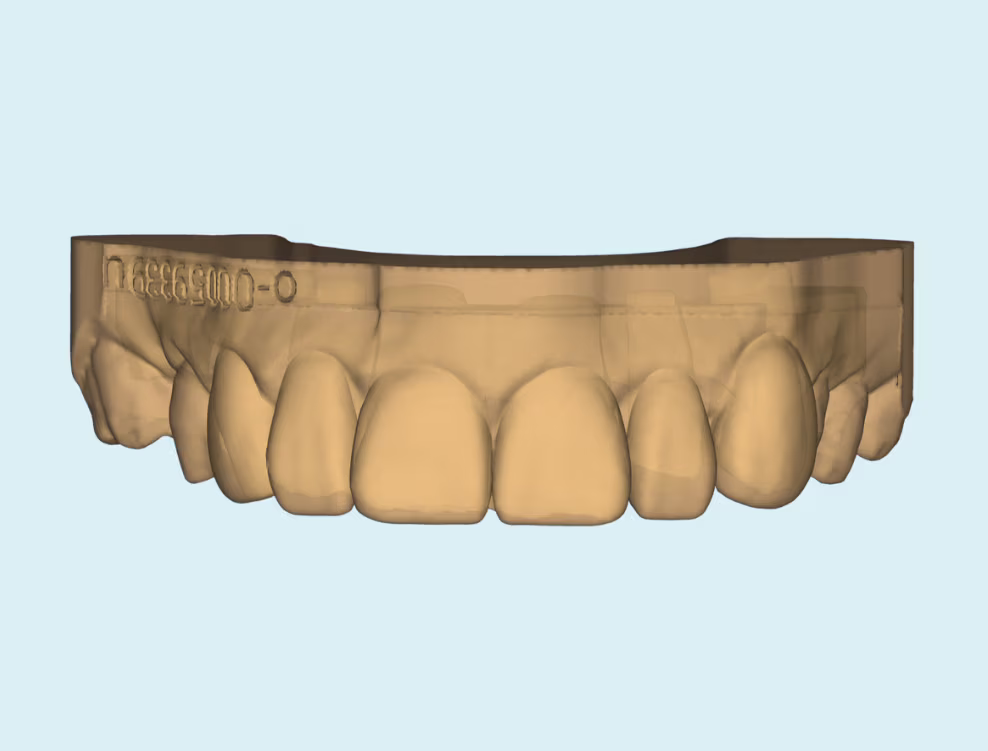 3D CAD design of persons top teeth with chip on front tooth