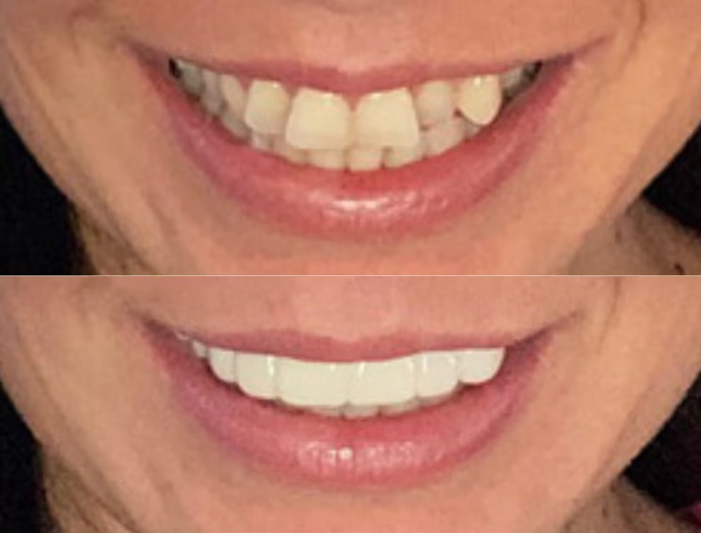 3D CAD design of persons top teeth with chip on front tooth