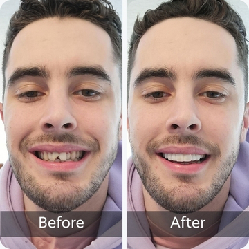 Chipped Teeth teeth