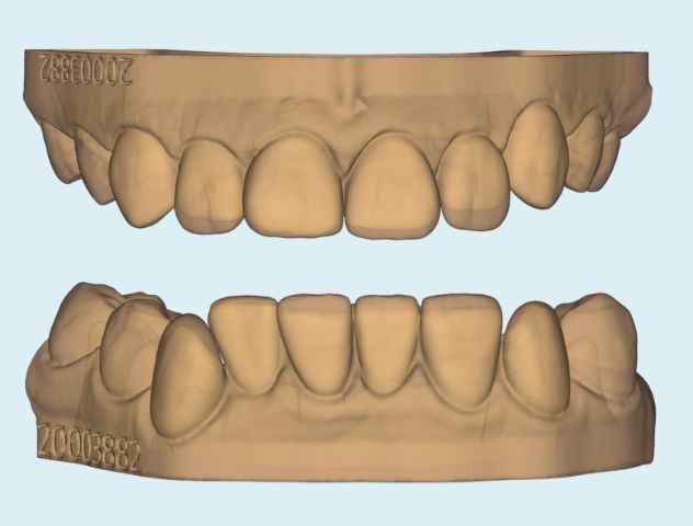 3D CAD design of persons top teeth with chip on front tooth