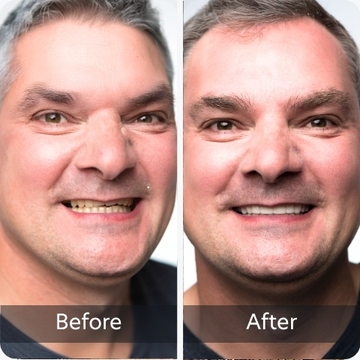 Worn Down Or Short Teeth teeth