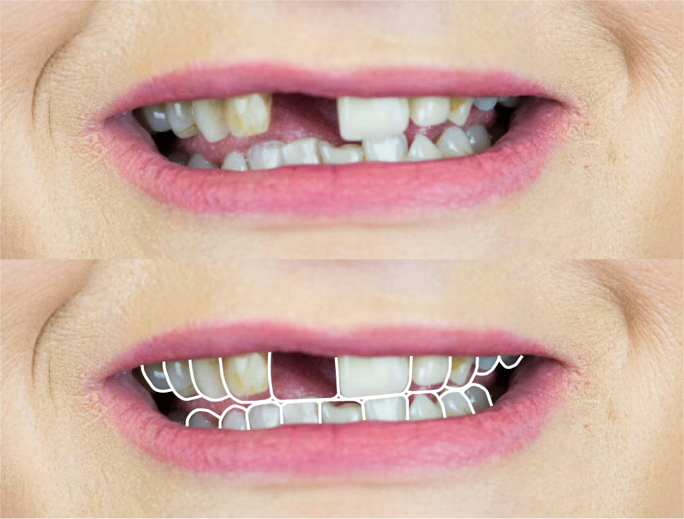 3D CAD design of persons top teeth with chip on front tooth