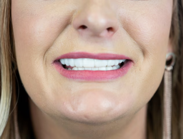 3D CAD design of persons top teeth with chip on front tooth