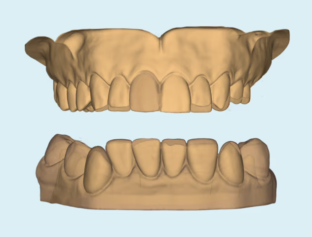 3D CAD design of persons top teeth with chip on front tooth