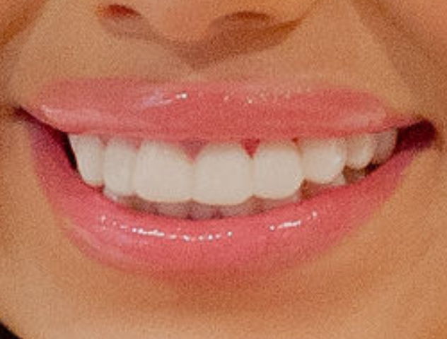 3D CAD design of persons top teeth with chip on front tooth