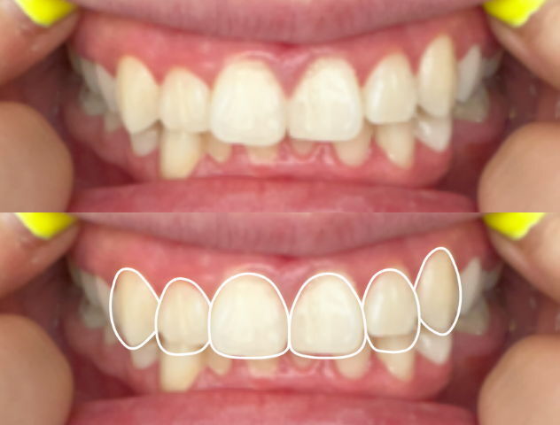 3D CAD design of persons top teeth with chip on front tooth