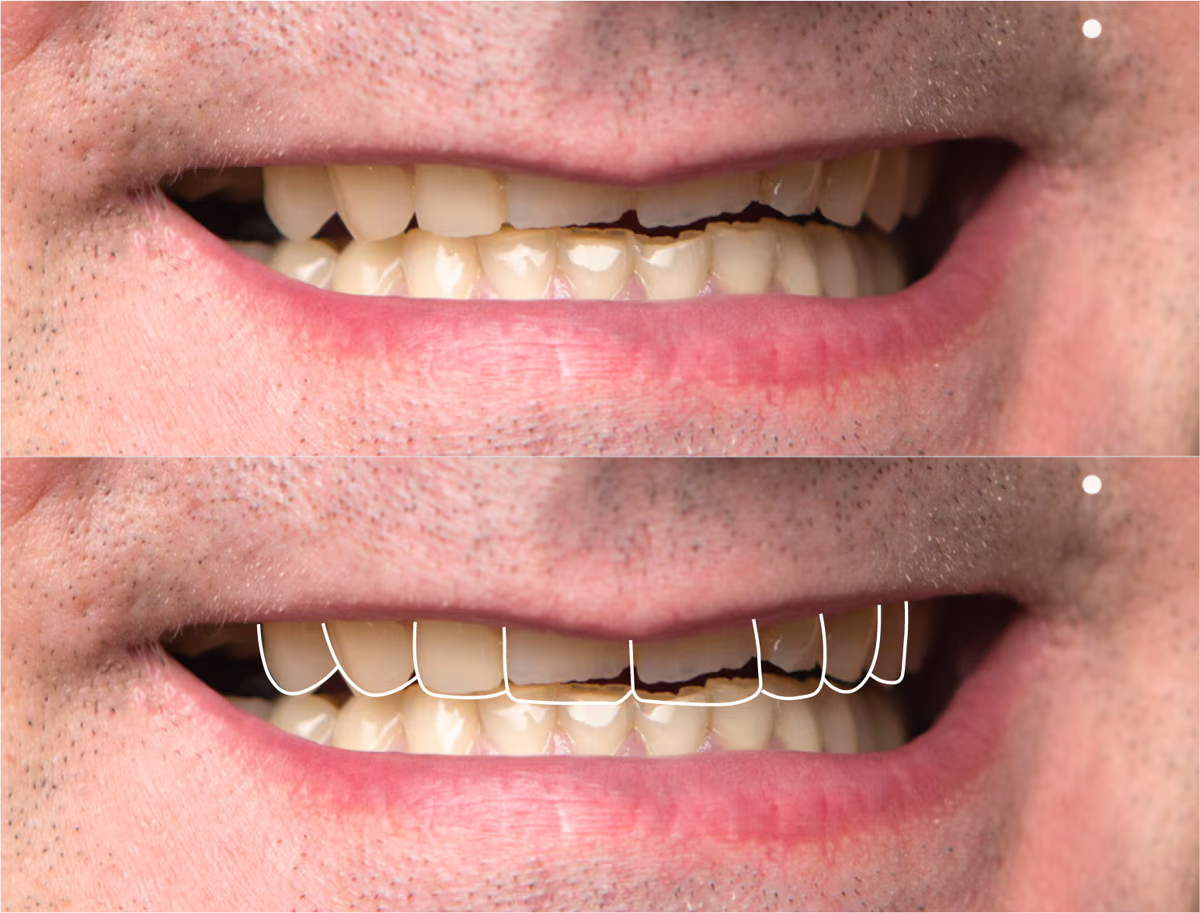 3D CAD design of persons top teeth with chip on front tooth