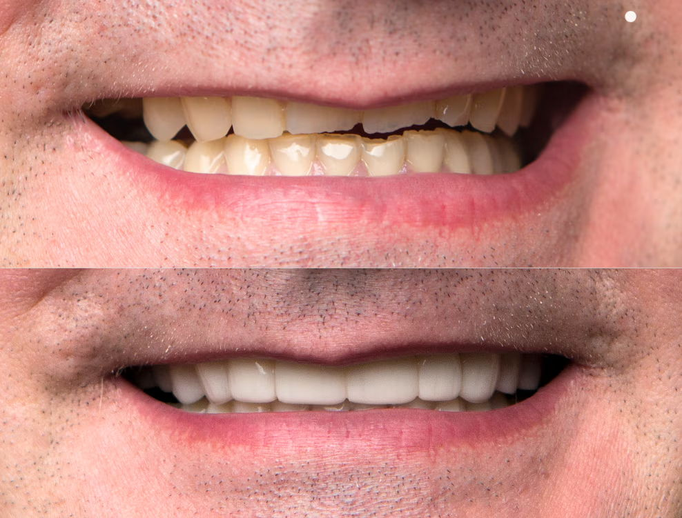 3D CAD design of persons top teeth with chip on front tooth