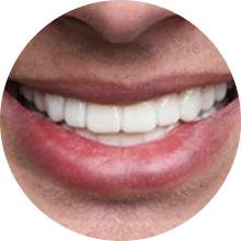 Light skin veneer user smiling