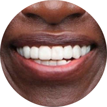 Dark skin veneer user smiling
