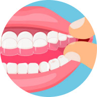 Clear aligners