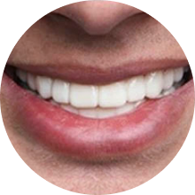 Light skin veneer user smiling