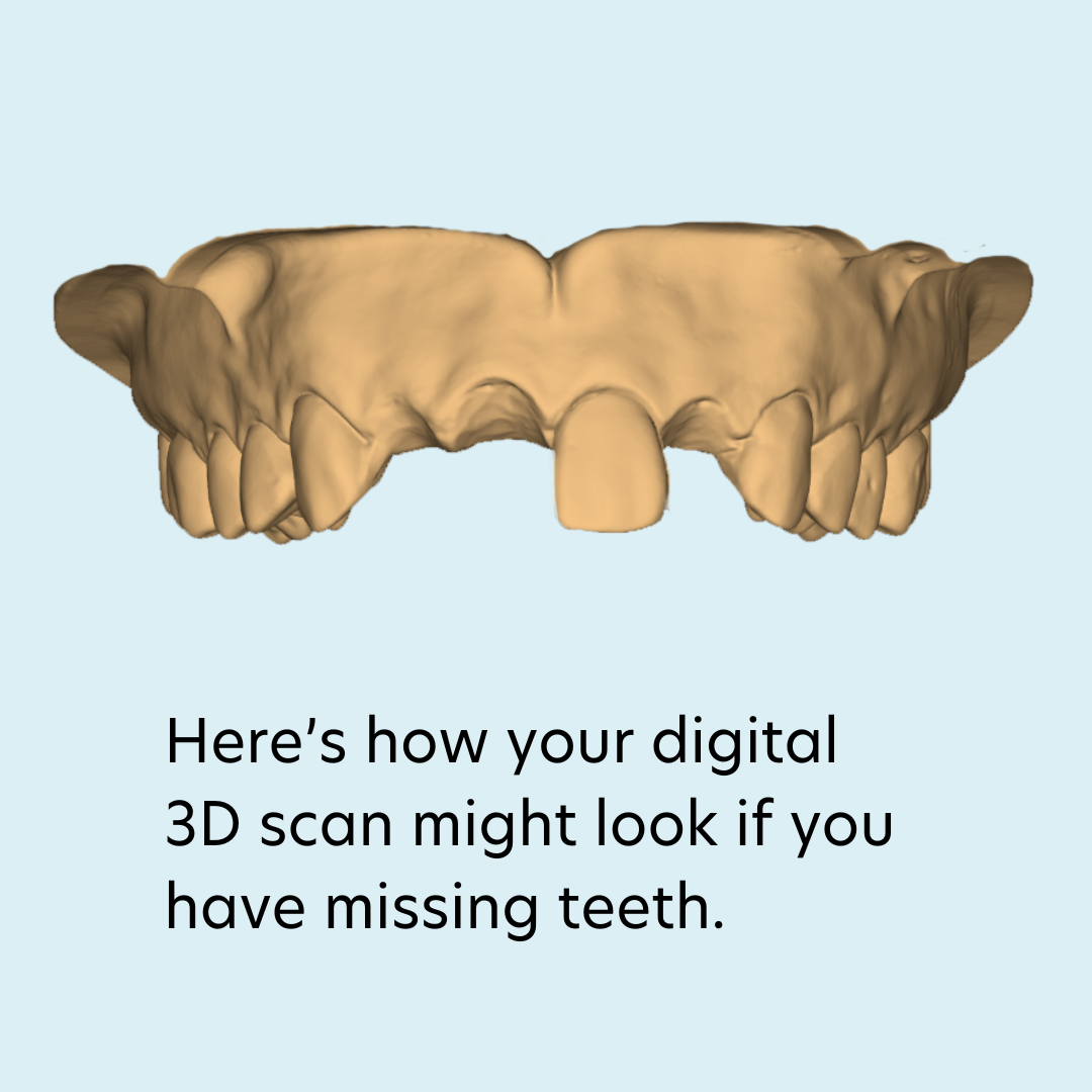 3D Scan of a person with missing teeth