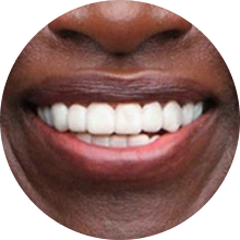 Dark skin veneer user smiling