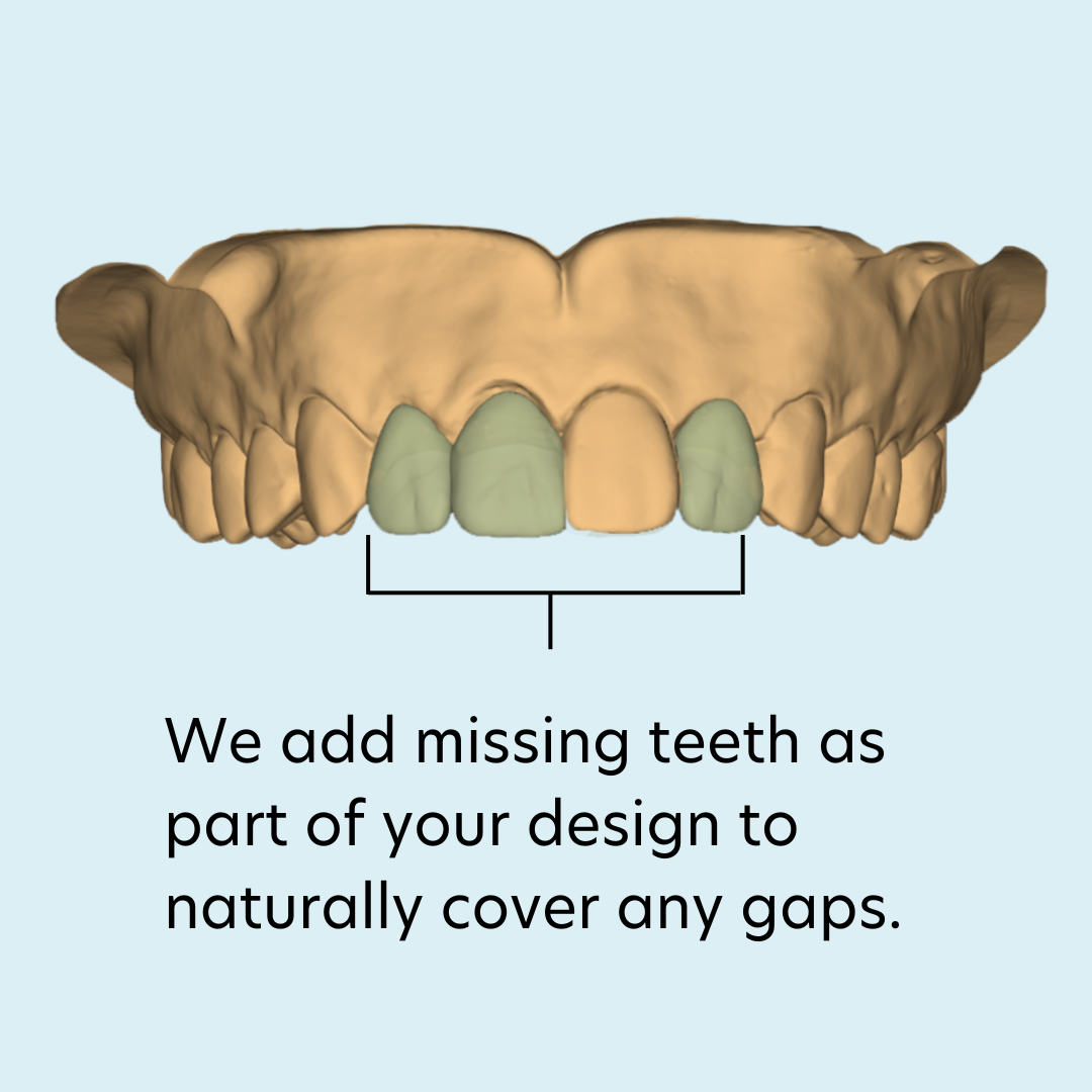 Adding missing teeth example