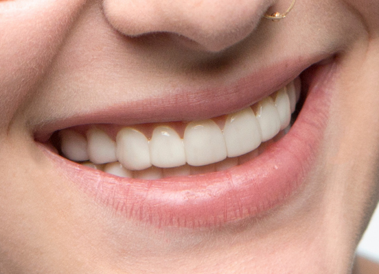 Woman with Instasmile veneers