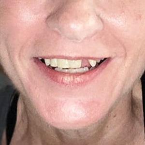 Design Missing Teeth