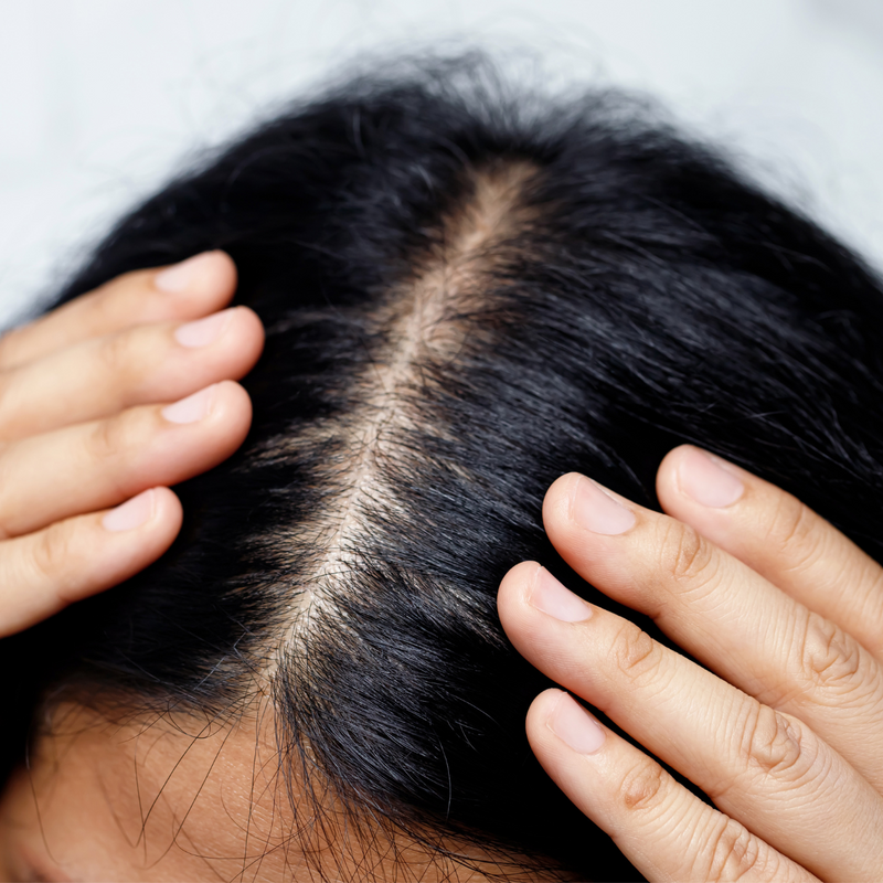 How to Prevent Traction Alopecia With Hair Toppers