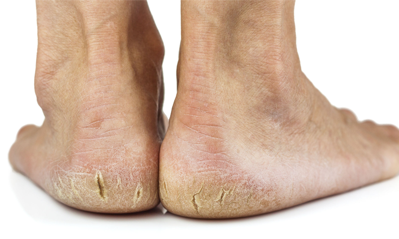 How To Spot The Signs Of A Diabetic Ulcer On The Foot: Midwest Institute  for Non-Surgical Therapy: Vascular and Interventional Radiologists