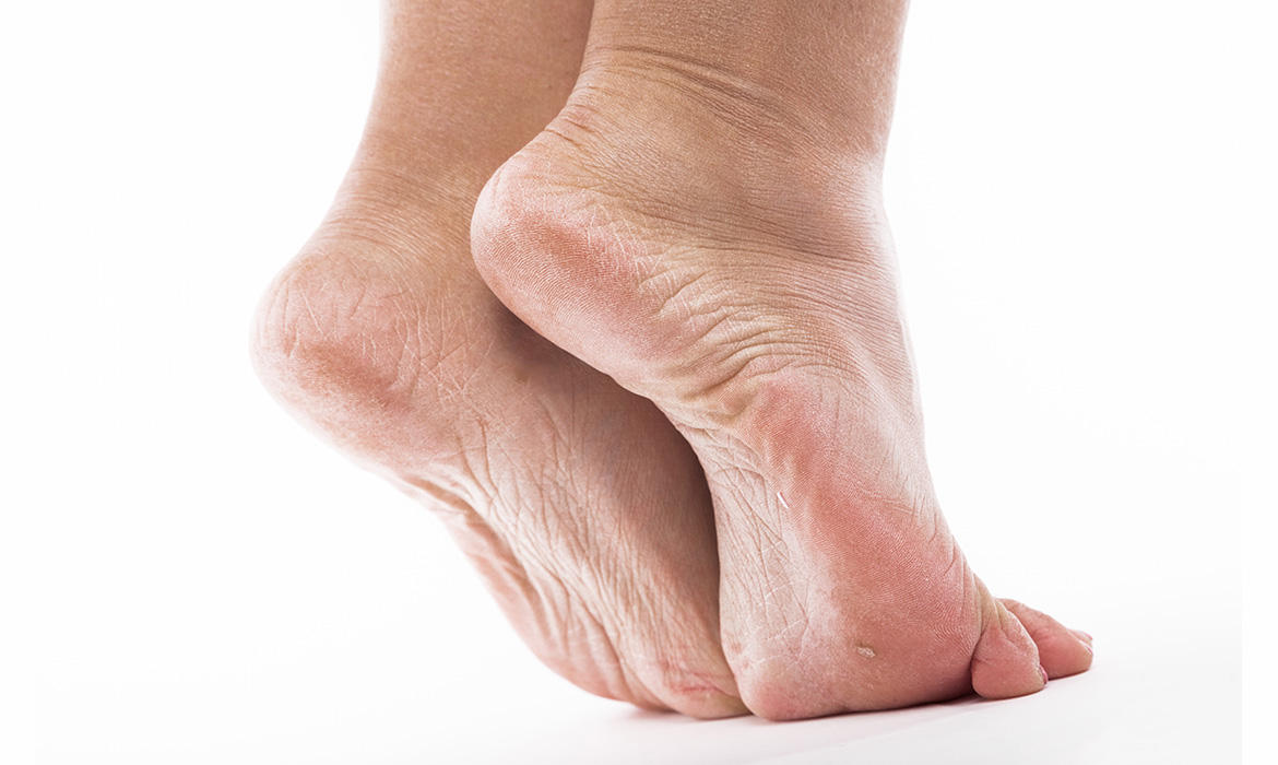 Cracked Heels and Heel Fissures | Foot & Ankle