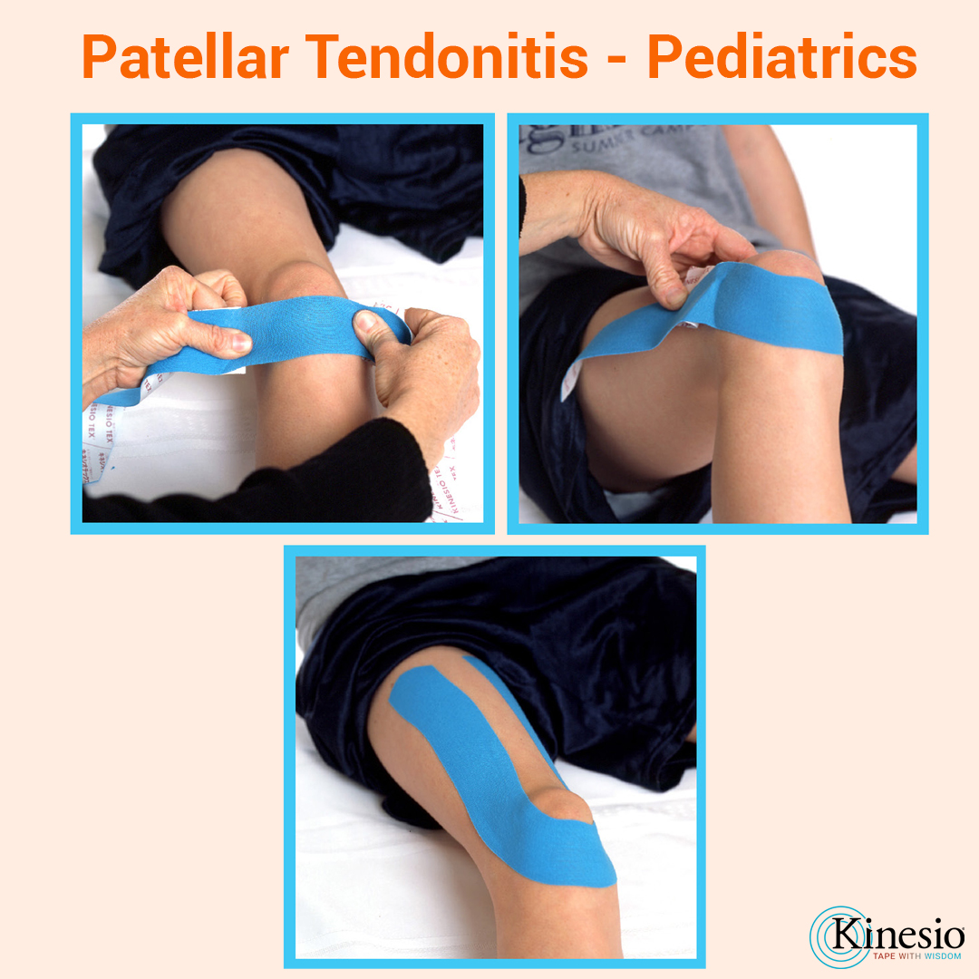 Patellar Tendonitis Taping  Kinesio Tape for Patellar Tendonitis – KT Tape