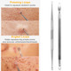 5-Piece Skincare Blackhead Remover Kit product
