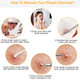 5-Piece Skincare Blackhead Remover Kit product