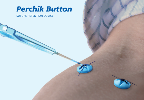 Angiodynamics H787138002015 Perchick Button, 13800201, Suture Retention Device. Box of 10