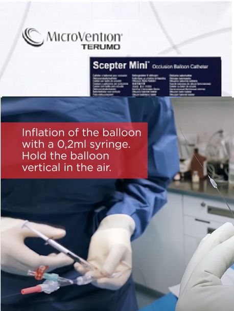 Terumo Neuro K01-07892 Scepter Mini™ High resolution 0.25 mL syringe for post-preparation balloon inflation. Box of 03