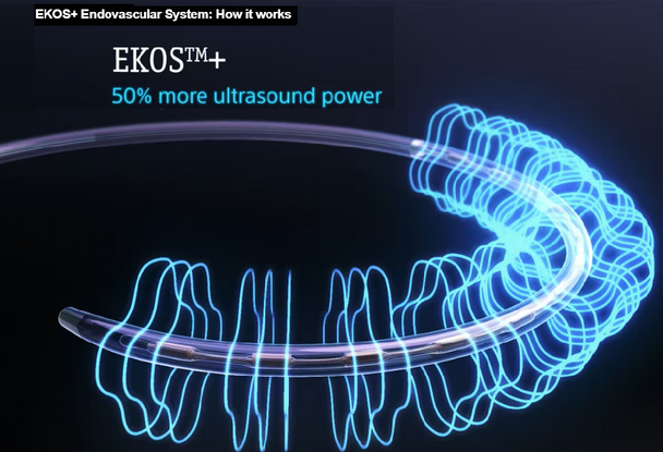 Boston Scientific H74939605106120 EKOS™+ Endovascular System, 7.8 Fr X 106 cm length, 12 cm Treatment zone, 0.035” compatible guidewire, Box of 01