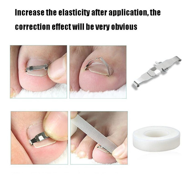 Orthopedic Buckle Toe Nail Groove Ingrown Nail Corrector, Style:No. 40, Specifications:Positive Nail Buckle