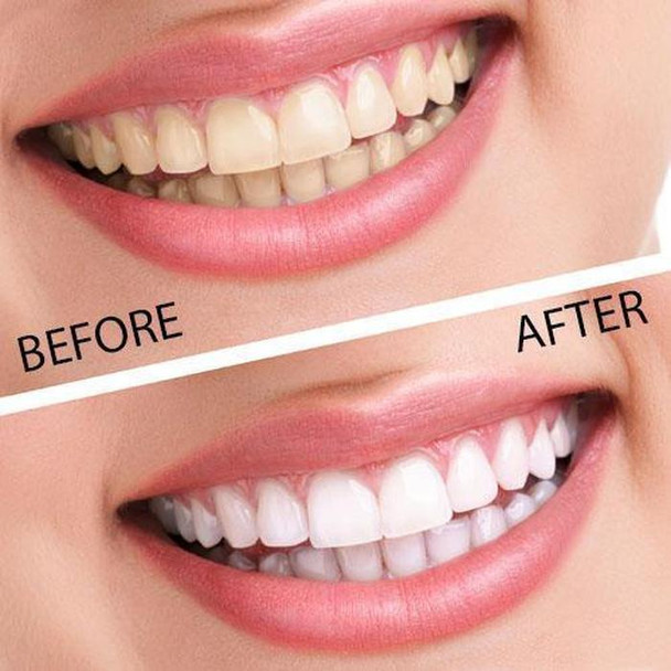 remedy-health-professional-teeth-whitening-home-kit-snatcher-online-shopping-south-africa-17784750768287.jpg