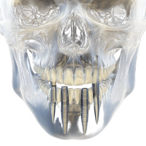 Zygomatic Dental Implants Vinyl Car Decal Sticker – Waterproof & UV-Resistant 8" Zygomatic Dental Implants Vinyl Car Decal Sticker – Waterproof & UV-Resistant 8"