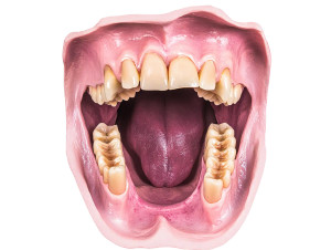 Decayed Teeth Closeup Vinyl Car Decal Sticker – Waterproof & UV-Resistant 8"